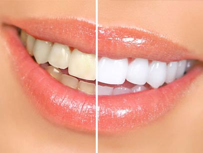 DtHakanAksu_Diş Beyazlatma (Bleaching)