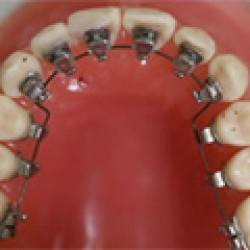 Diş Teli Takmaktan Utananlara Müjde!