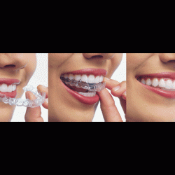 Şeffaf Düzeltici OrthoClear Nedir?