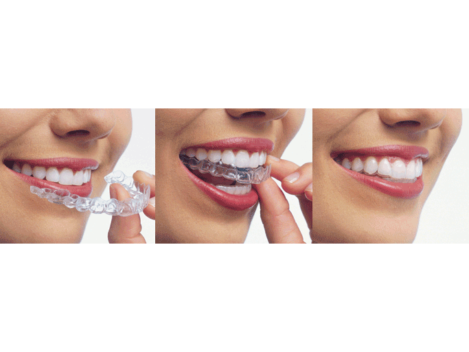 DtHakanAksu_Şeffaf Düzeltici OrthoClear Nedir